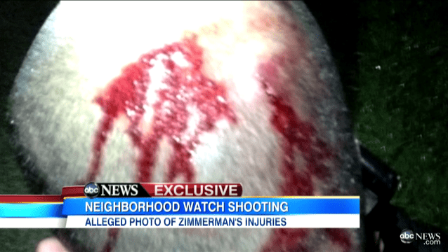Zimmerman_Wounded_Head.png